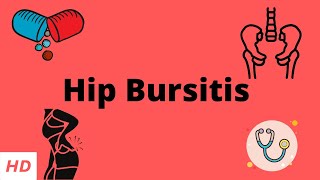 Hip Bursitis Causes Signs and Symptoms Diagnosis and Treatment [upl. by Reiss]