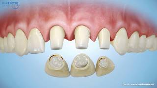 Are Porcelain Veneers Right for You [upl. by Rondi640]