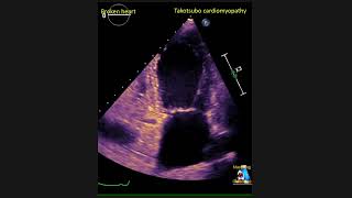 Takotsubo Cardiomyopathy  Broken Heart shorts [upl. by Namilus217]