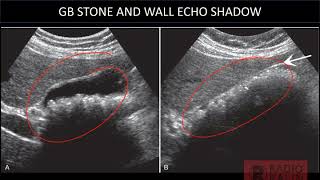 USG GALLBLADDER CALCULUS  WALL ECHO SHADOWPORCELAIN GB [upl. by Noswad]