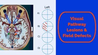 Visual pathway lesions and field defects [upl. by Shirley]