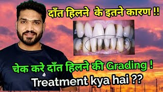 दाँतो का हिलना  कारण और इलाज  Tooth mobility Causes  Grading and treatment [upl. by Iralam452]