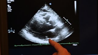 Echocardiogram Demonstration [upl. by Aztiram406]