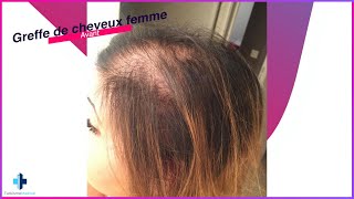 Greffe de cheveux femme avantaprès résultat a 10 mois 😱  Turkisme Medical [upl. by Nahraf119]