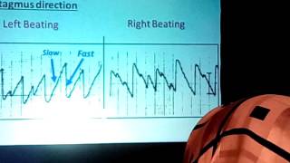 Caloric Test Procedures amp Interpretation Prof Dr Adel Abdel Maksoud 1 [upl. by Ellekcim169]