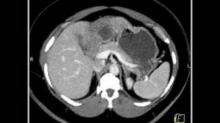 Abdomen Liver Hemangioma of the Liver8 of 8 [upl. by Luckin]