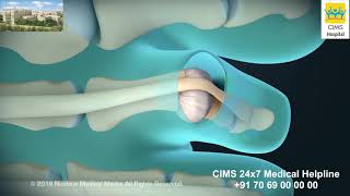 Hammertoe and Claw Toe Correction – CIMS Hospital [upl. by Garv]