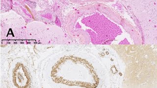 vascular malformation in skin histopathology Slides [upl. by Philo]