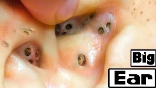 Deep Removal Of Blackheads In The Ear [upl. by Claudius]