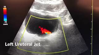 Hydronephrosis and Ureteral Jets [upl. by Annhej]