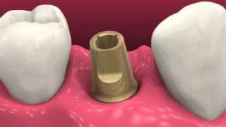 Restoring dental implants video BioHorizons [upl. by Okubo963]