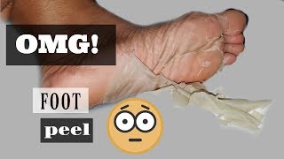 First Time Trying A Natural Foot Peel  Earth Therapeutics Foot Peel Review [upl. by Aray76]