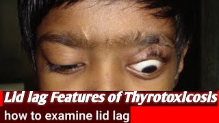 Lid lag examination  Features of thyrotoxicosis [upl. by Tengler711]