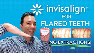 Fix Your Flared Teeth With Invisalign WITHOUT Extractions Invisalign and IPR Method [upl. by Delmor]