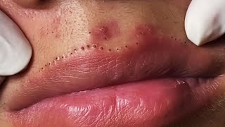 Lips Blackhead removal Video 53 Blackheads blackheadsremoval sebum [upl. by Atir]