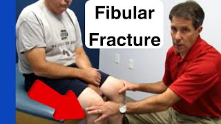 Proximal Fibular Fracture clinical exam [upl. by Esilanna]