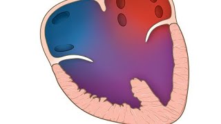 Hydrops fetalis because of cardiac anomaly  Atrioventricular septal defects AVSDs [upl. by Adalbert]