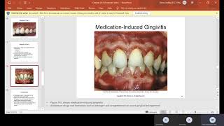 CH 14 Periodontal Diseases [upl. by Alberic]