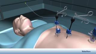 Colecistectomía Laparoscópica con el Sistema Weck® Hemolock® Auto Endo 5® [upl. by Othilie]