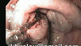 Adenomatous polyp of pyloric Endoscopic diagnosis [upl. by Gert]