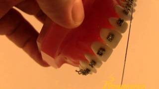 How to Use the Weingart Plier Powerprox Six Month Braces Orthodontic Education Video [upl. by Enitsyrk]