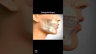 Corrective Jaw Surgery  Orthognathic Surgery  animation shorts [upl. by Aikaj]