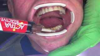 Activa Splinting of loose lower front teeth quick and cost effective [upl. by Purpura]