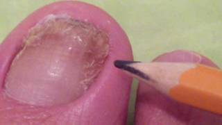 TOENAIL FUNGUS DOCUMENTARY DAY 184 [upl. by Alveta]