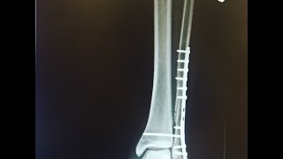 Recovery from fibula surgery [upl. by Yortal]