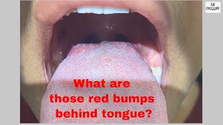 What are Red bumps behind Tongue  Taste Buds How to keep them clean and healthy [upl. by Anirdua]