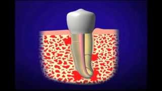 Introduction to Root Canal Treatment with Dr Ruddle [upl. by Sabelle170]