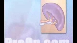 PreOp® Patient Education Spleen Removal Laparoscopic Splenec [upl. by Kaufman]