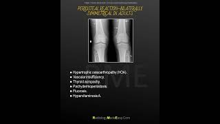 Periosteal reactions Bilaterally symmetrical in adults [upl. by Darees]