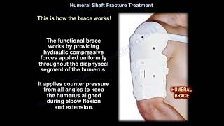 Humeral Shaft Fracture Treatment  Everything You Need To Know  Dr Nabil Ebraheim [upl. by Hun]