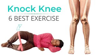 6 Best knock Knee Correction Exercise in Hindi [upl. by Aydne657]