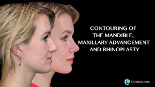 Contouring of the mandible rhinoplasty CASE 2 [upl. by Llenet]