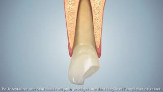 les Couronnes dentaires sur une dent sur plusieurs sur implant [upl. by Ahsya]