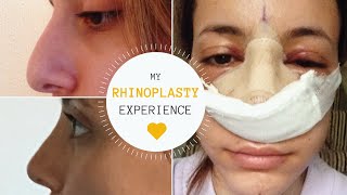 I GOT A NOSE JOB  THE BEST SURGEON  Rhinoplasty Experience [upl. by Dranoel702]