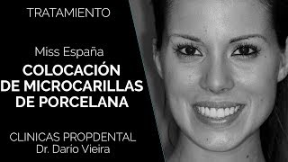 Carillas de Porcelana de la Miss España para Miss Universo [upl. by Eico]