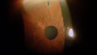 Iridotomia Laser per Glaucoma  Studi Oculistici Abbondanza [upl. by Atsocal657]