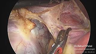 Fibroid Uterus with Dermoid Cyst [upl. by Crist]