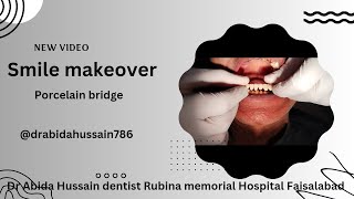 smile Makeover with porcelain bridge dentistry dentista drabidahussain786 drabidahussain786 [upl. by Rutherfurd]