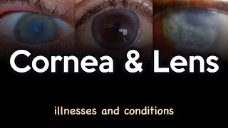 Cornea and Lens Illnesses and Conditions [upl. by Ahsemrak]