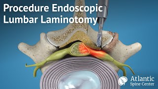 Procedure Endoscopic Lumbar Laminotomy [upl. by Ditzel]