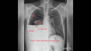 Chest X rays Part 2  Pleural effusion Hydropneumothorax Pneumothorax [upl. by Adnalohs]