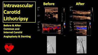 ShockWave Intravascular Carotid Lithotripsy Highly Calcified Carotid Stenosis [upl. by Petrie]