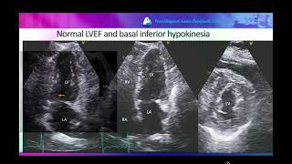 Normal LVEF and reduced GLS in a patient with triple vessel CAD [upl. by Dao]