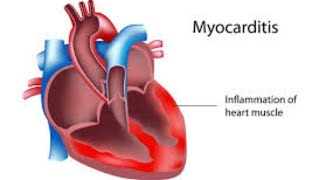 شرح Myocarditis 💓💯💫 [upl. by Anaylil397]