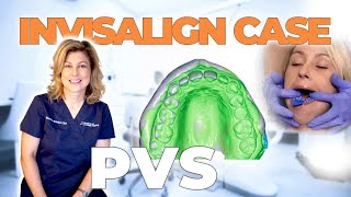 How To Take PVS Dental Impressions for Invisalign [upl. by Kati441]