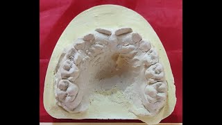 Age determination of Mixed Dentition cast [upl. by Sidoeht]